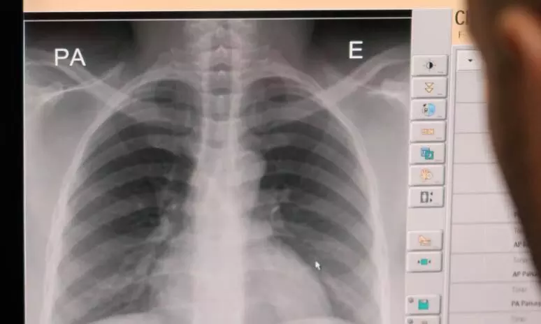 കോവിഡ് മുക്തരിൽ ക്ഷയരോഗം; കർണ്ണാടകയിൽ പ്രത്യേക പരിശോധന കാ​മ്പ​യി​ൻ