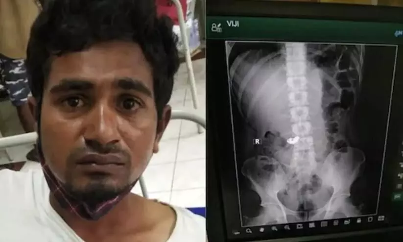 Bengaluru Thief Swallows Gold Chain visible in the X-ray