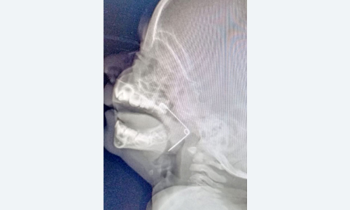 പത്തുമാസമുള്ള കുഞ്ഞിന്‍റെ തൊണ്ടയിൽ കുടുങ്ങിയ സേഫ്റ്റിപിൻ പുറത്തെടുത്തു