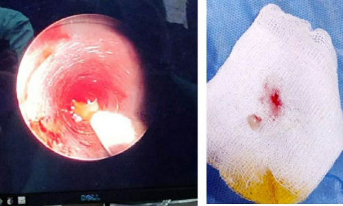 ശ്വാസകോശത്തിൽ കുടുങ്ങിയ പല്ല് പുറത്തെടുത്തു ആറു വയസ്സുകാരിക്ക് പുതുജന്മം