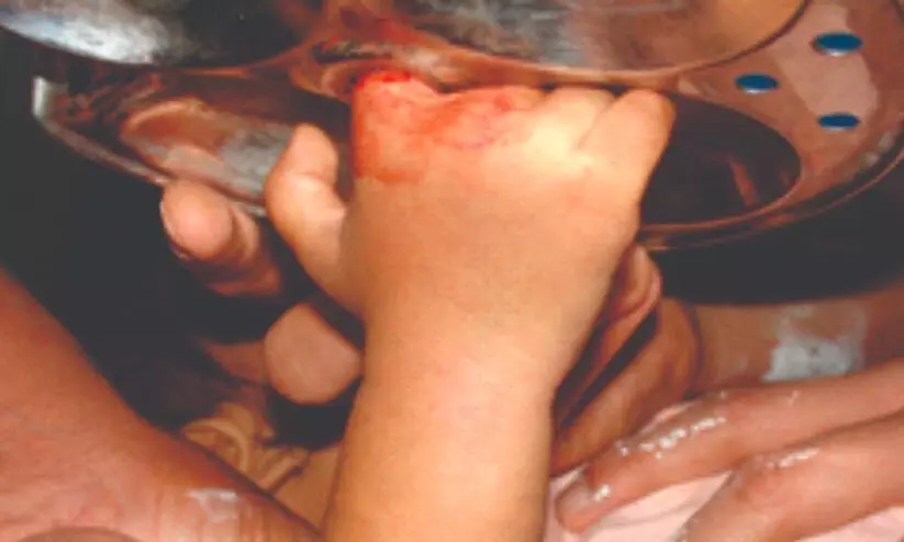 മൂ​ന്ന് വ​യ​സ്സു​കാ​രി​യു​ടെ വി​ര​ൽ ഇ​ഡ്ഡ​ലി​ത്ത​ട്ടി​ൽ കു​ടു​ങ്ങി; ര​ക്ഷ​ക​രാ​യി പൊ​ലീ​സ്​