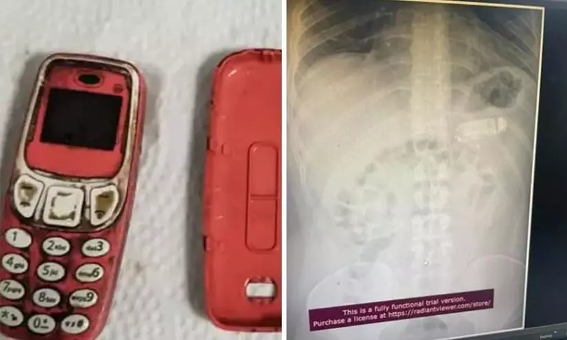 Man swallows entire Nokia 3310 phone undergoes surgery