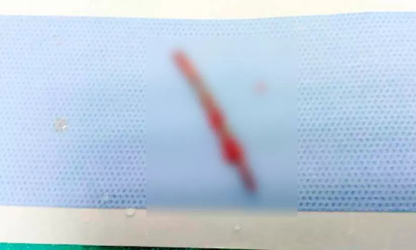 ജോലിക്കിടെ നെഞ്ചിൽ തറച്ച ഇരുമ്പുചീള്​ പുറത്തെടുത്തു