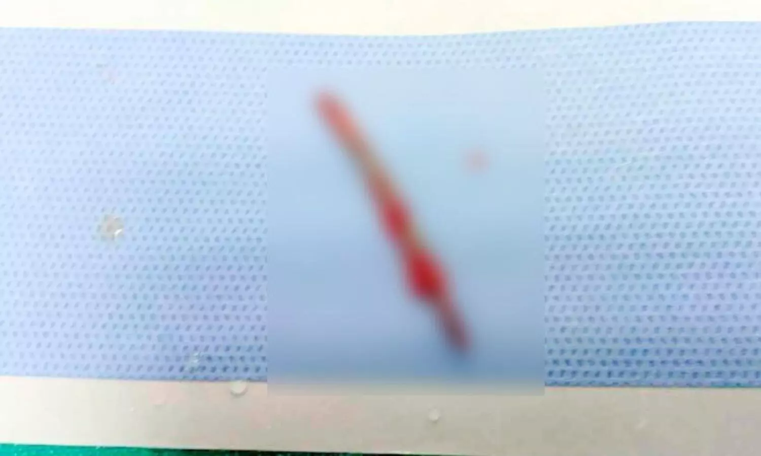 ജോലിക്കിടെ നെഞ്ചിൽ തറച്ച ഇരുമ്പുചീള്​ പുറത്തെടുത്തു