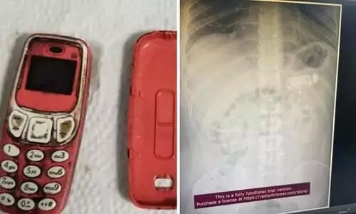 Man swallows entire Nokia 3310 phone undergoes surgery