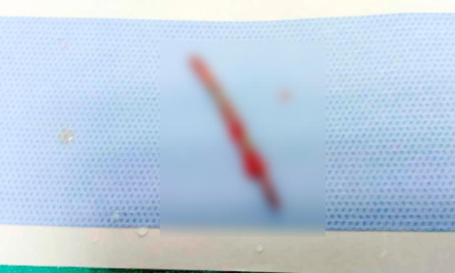 ജോലിക്കിടെ നെഞ്ചിൽ തറച്ച ഇരുമ്പുചീള്​ പുറത്തെടുത്തു