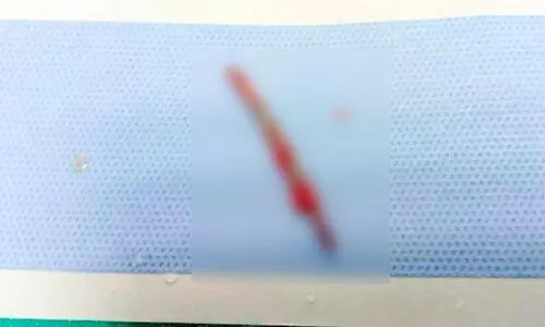 ജോലിക്കിടെ നെഞ്ചിൽ തറച്ച ഇരുമ്പുചീള്​ പുറത്തെടുത്തു