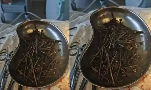 കടുത്ത വയറുവേദന; രോഗിയുടെ വയറ്റിൽനിന്ന്​ ഒരു കിലോ സ്​ക്രൂവും ആണിയും നീക്കം ചെയ്​തു