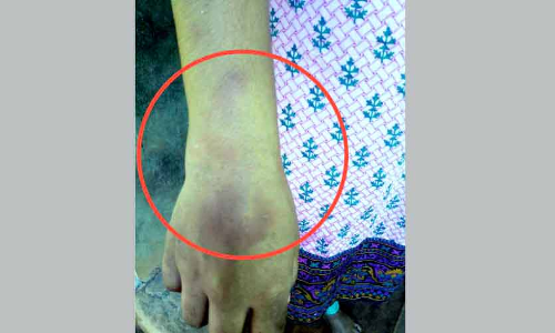 ഭ​ർ​ത്താ​വു​മാ​യി പി​ണ​ങ്ങി​യ യു​വ​തി​ക്ക് ക്രൂ​ര​മ​ർ​ദ​നം : പൊലീസ്​ കേസ്​ അട്ടിമറിച്ചെന്ന്