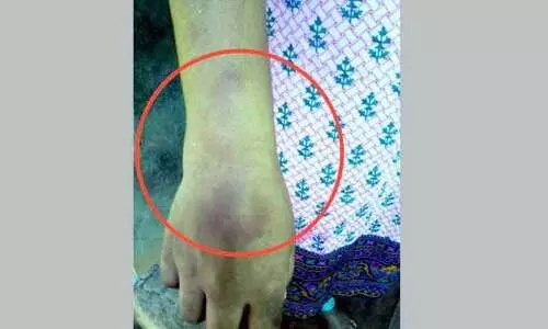 ഭ​ർ​ത്താ​വു​മാ​യി പി​ണ​ങ്ങി​യ യു​വ​തി​ക്ക് ക്രൂ​ര​മ​ർ​ദ​നം : പൊലീസ്​ കേസ്​ അട്ടിമറിച്ചെന്ന്