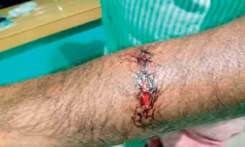 അ​രി​പ്ര​യി​ൽ തെ​രു​വു​നാ​യ് ശ​ല്യം; മൂ​ന്നു​പേ​ർ​ക്ക് ക​ടി​യേ​റ്റു