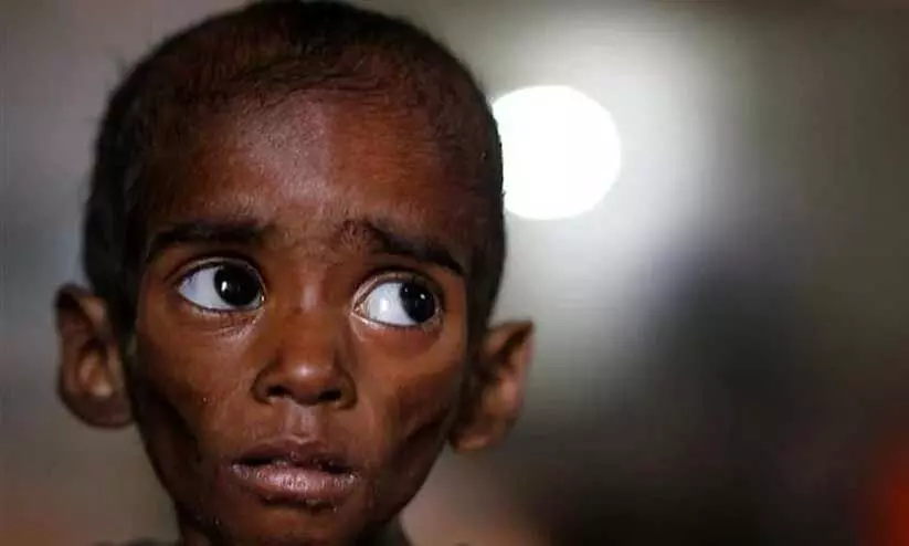 രാജ്യത്ത് പോഷകാഹാരക്കുറവുള്ള കുട്ടികൾ 33 ലക്ഷം രാജ്യത്ത് പോഷകാഹാരക്കുറവുള്ള കുട്ടികൾ 33 ലക്ഷം