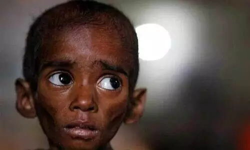 രാജ്യത്ത്​ പോഷകാഹാരക്കുറവുള്ള കുട്ടികൾ 33 ലക്ഷം