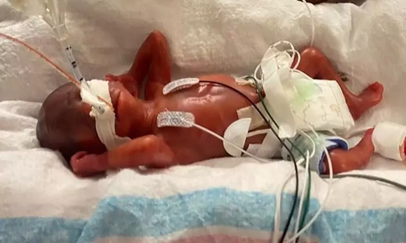 Alabama boy certified as worlds most premature baby