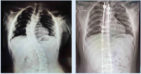 ഗവ. മെഡിക്കൽ കോളജ് ആശുപത്രിയിൽ നട്ടെല്ല് നിവർത്തുന്ന ശസ്ത്രക്രിയ ഗവ. മെഡിക്കൽ കോളജ് ആശുപത്രിയിൽ നട്ടെല്ല് നിവർത്തുന്ന ശസ്ത്രക്രിയ