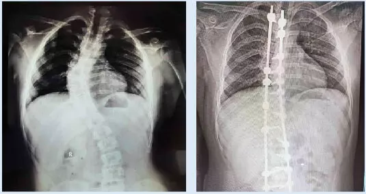 ഗവ. മെഡിക്കൽ കോളജ് ആശുപത്രിയിൽ നട്ടെല്ല് നിവർത്തുന്ന ശസ്ത്രക്രിയ ഗവ. മെഡിക്കൽ കോളജ് ആശുപത്രിയിൽ നട്ടെല്ല് നിവർത്തുന്ന ശസ്ത്രക്രിയ