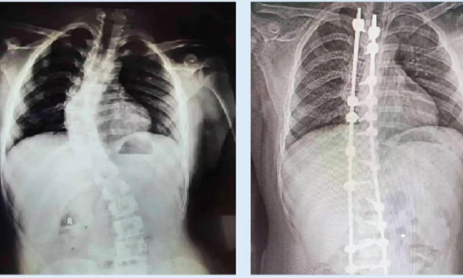 ഗവ. മെഡിക്കൽ കോളജ് ആശുപത്രിയിൽ നട്ടെല്ല് നിവർത്തുന്ന ശസ്ത്രക്രിയ