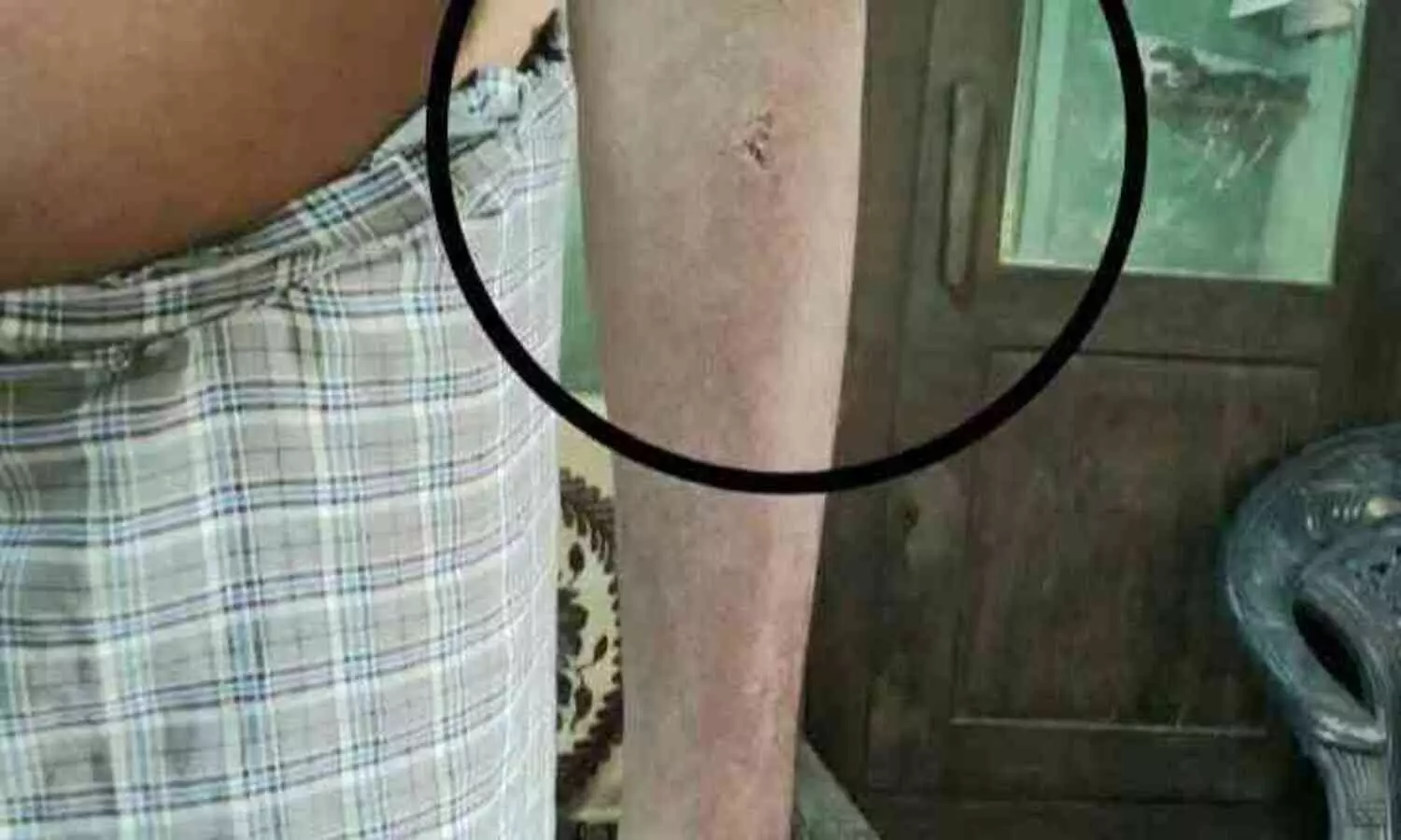 മലയിൻകീഴിൽ പേപ്പട്ടിയുടെ ആക്രമണം; നിരവധി പേർക്ക് കടിയേറ്റു