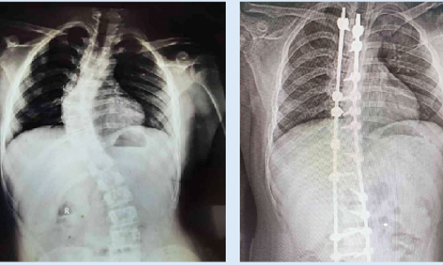 ഗവ. മെഡിക്കൽ കോളജ് ആശുപത്രിയിൽ നട്ടെല്ല് നിവർത്തുന്ന ശസ്ത്രക്രിയ