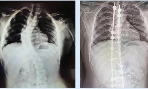 ഗവ. മെഡിക്കൽ കോളജ് ആശുപത്രിയിൽ നട്ടെല്ല് നിവർത്തുന്ന ശസ്ത്രക്രിയ