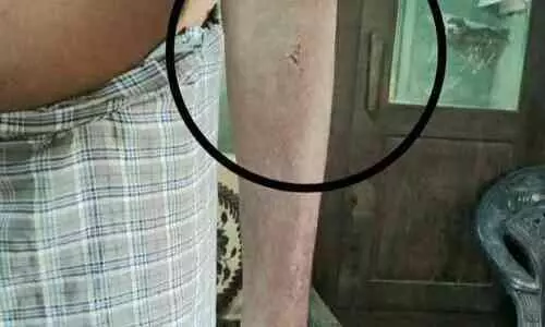 മലയിൻകീഴിൽ പേപ്പട്ടിയുടെ ആക്രമണം; നിരവധി പേർക്ക് കടിയേറ്റു