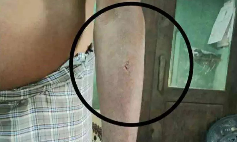 മലയിൻകീഴിൽ പേപ്പട്ടിയുടെ ആക്രമണം; നിരവധിപേർക്ക് കടിയേറ്റു