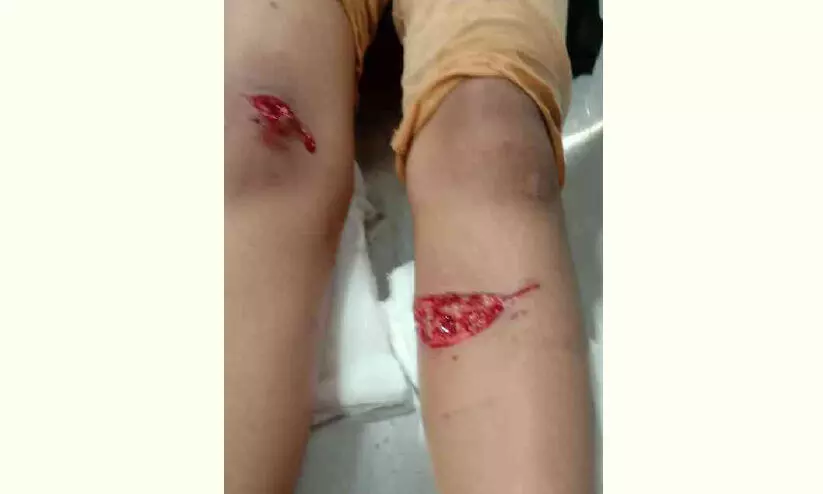 ചായ്ക്കോട്ടുകോണത്ത് നിരവധി പേര്ക്ക് നായുടെ കടിയേറ്റു ചായ്ക്കോട്ടുകോണത്ത് നിരവധി പേര്ക്ക് നായുടെ കടിയേറ്റു