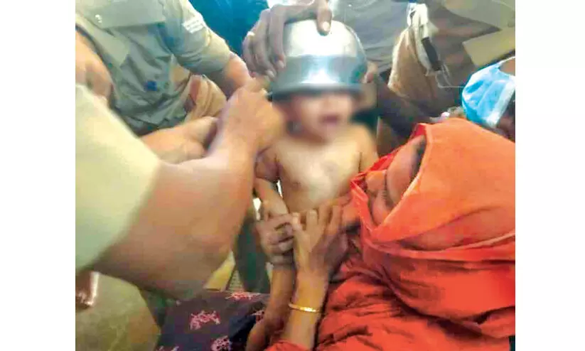 ഒരു വയസ്സുകാരിയുടെ തലയിൽ കുടുങ്ങിയ പാത്രം മുറിച്ചുമാറ്റി