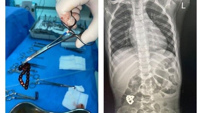 കുട്ടിയുടെ വയറ്റിൽനിന്ന് ബ്രേസ്​ലെറ്റ്​ പുറത്തെടുത്തു