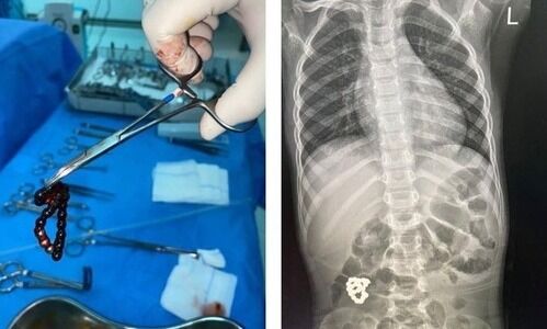 കുട്ടിയുടെ വയറ്റിൽനിന്ന് ബ്രേസ്​ലെറ്റ്​ പുറത്തെടുത്തു