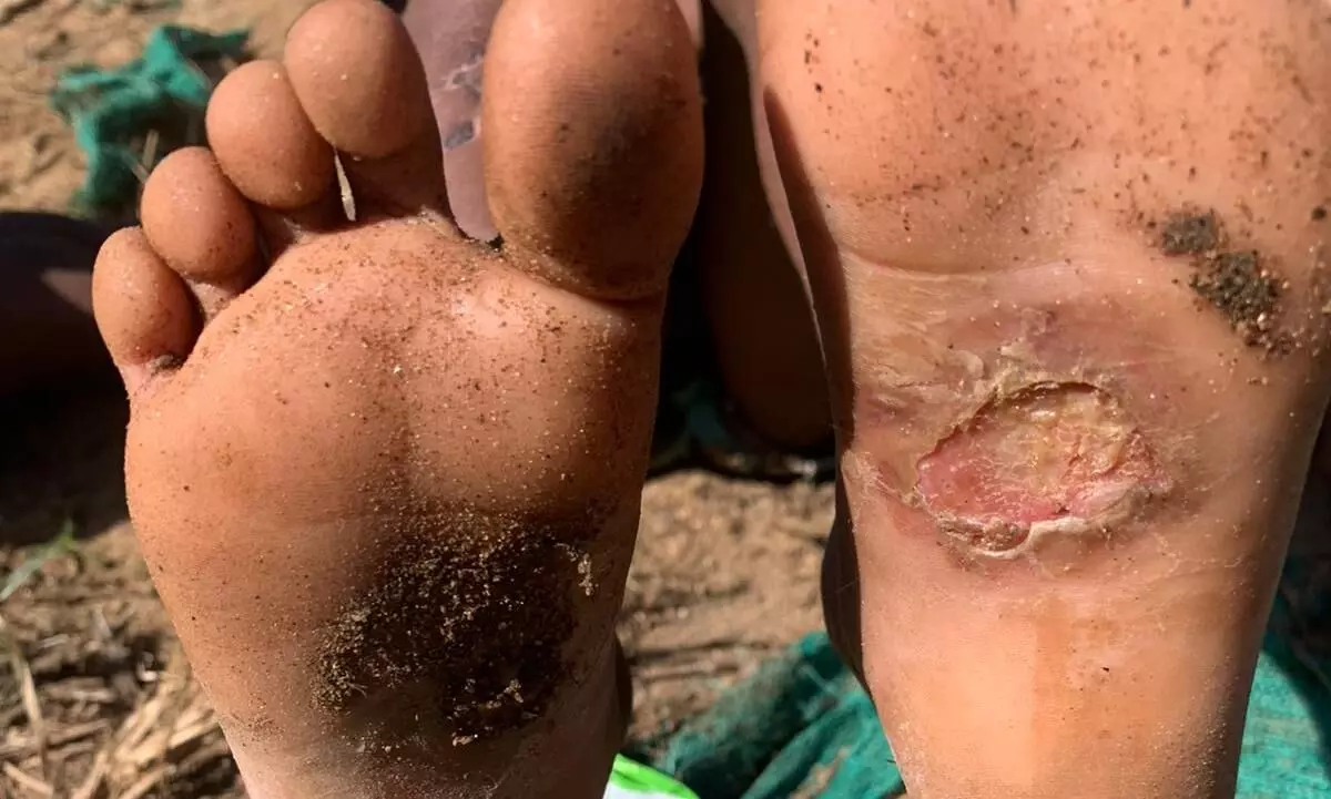 അനുസരണയില്ലെന്ന്; അഞ്ചുവയസുകാരനെ പൊള്ളലേല്‍പ്പിച്ച് അമ്മയുടെ ക്രൂരത