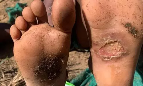 അനുസരണയില്ലെന്ന്; അഞ്ചുവയസുകാരനെ പൊള്ളലേല്‍പ്പിച്ച് അമ്മയുടെ ക്രൂരത