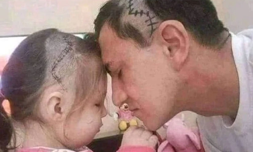 മകളേ നിനക്കായ്​... ശസ്​ത്രക്രിയക്ക്​ വിധേയയായ മകളുടെ തലയിലെ തുന്നൽ അനുകരിച്ച്​ അച്ഛൻ