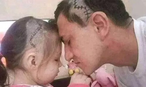 മകളേ നിനക്കായ്​... ശസ്​ത്രക്രിയക്ക്​ വിധേയയായ മകളുടെ തലയിലെ തുന്നൽ അനുകരിച്ച്​ അച്ഛൻ