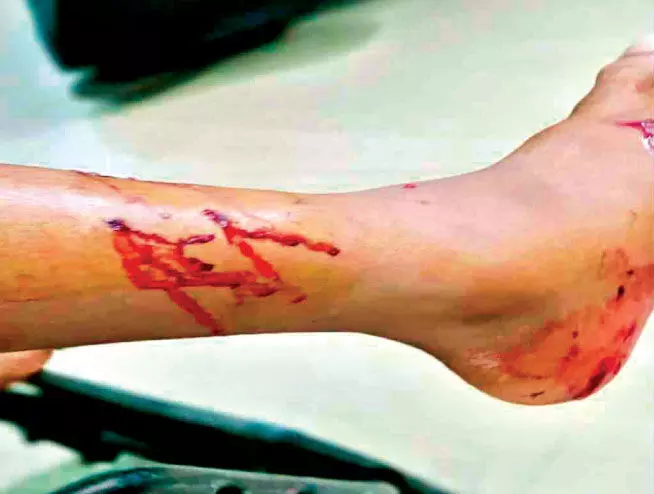 Sea otter bite Three children were injured Sea otter bite Three children were injured