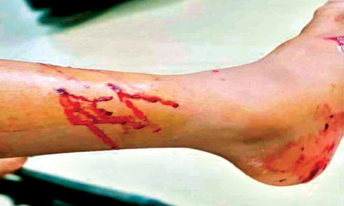 Sea otter bite Three children were injured