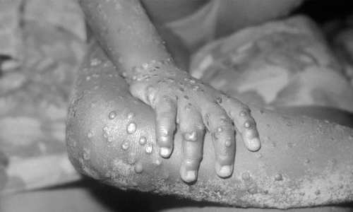 വയനാട്ടിൽ കുരങ്ങുപനി സ്ഥിരീകരിച്ചു; അറിയാം ല​ക്ഷ​ണ​ങ്ങ​ളും മു​ൻ​ക​രു​തലും