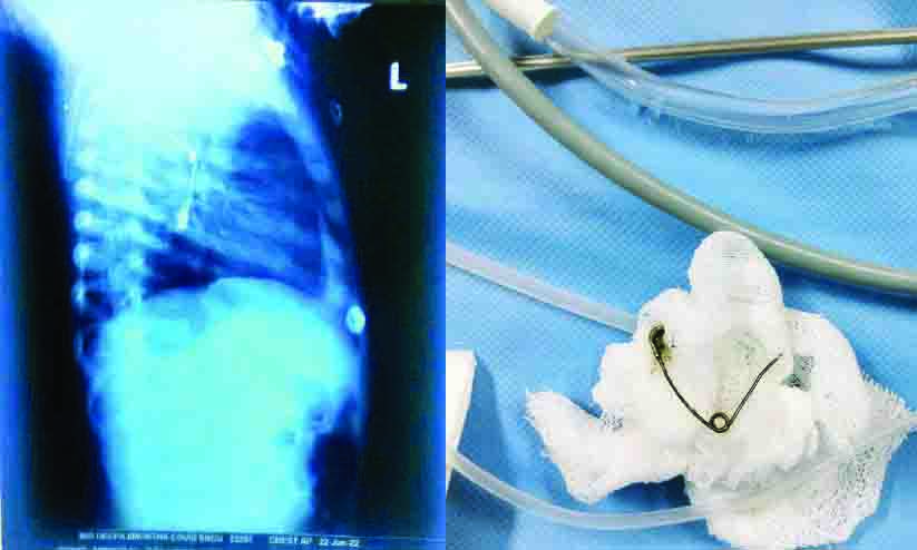 പിഞ്ചുകുഞ്ഞിന്റെ അന്നനാളത്തിൽ കുടുങ്ങിയ സേഫ്റ്റി പിൻ പുറത്തെടുത്തു പിഞ്ചുകുഞ്ഞിന്റെ അന്നനാളത്തിൽ കുടുങ്ങിയ സേഫ്റ്റി പിൻ പുറത്തെടുത്തു