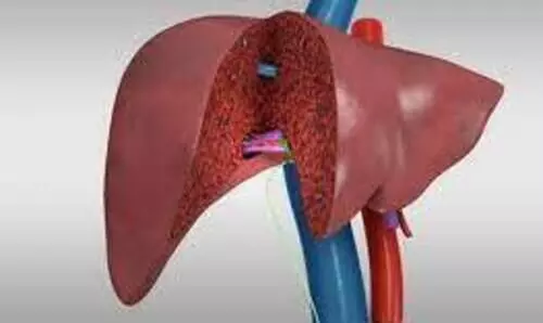 liver transplant surgery