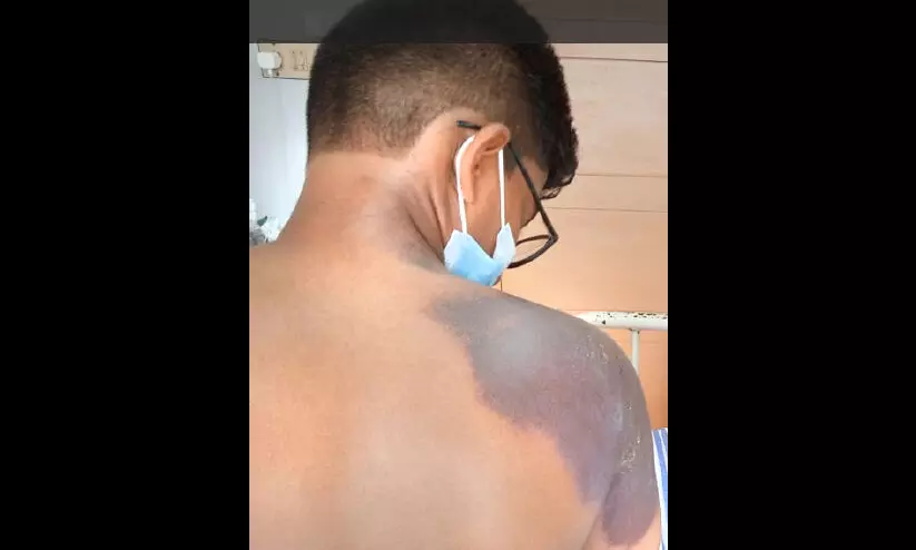 ഉപ്പിലിട്ടത് വിൽക്കുന്ന കടയിലെ രാസലായനി കുടിച്ച് രണ്ടുകുട്ടികൾക്ക് പൊള്ളലേറ്റു