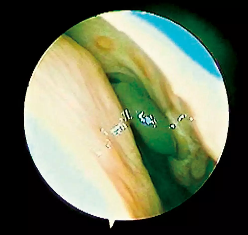 Pulled out the kula atta that had gotten into his nose