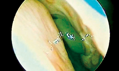 Pulled out the kula atta that had gotten into his nose