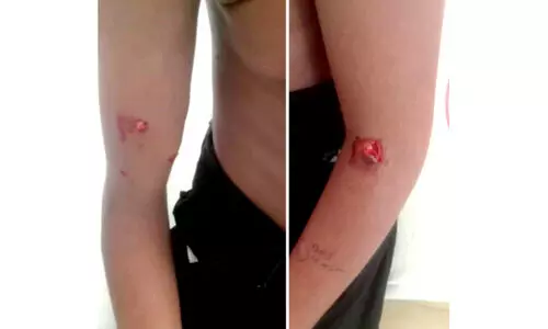 തെരുവുനായുടെ ആക്രമണം; ആ​റാം​മൈ​ലിൽ മൂന്നു പേർക്ക് കടിയേറ്റു