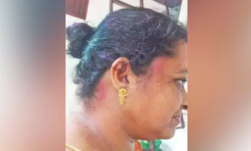 തൊഴിലുറപ്പ് ജോലിക്കിടെ സൂര്യാതപമേറ്റു