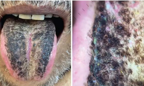 black hair tongue