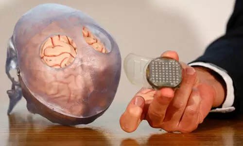 തളർച്ച ബാധിച്ച രോഗിക്ക് ആശയവിനിമയം; സാധ്യമാക്കി മസ്തിഷ്കത്തിലെ മൈക്രോ ചിപ്പ്