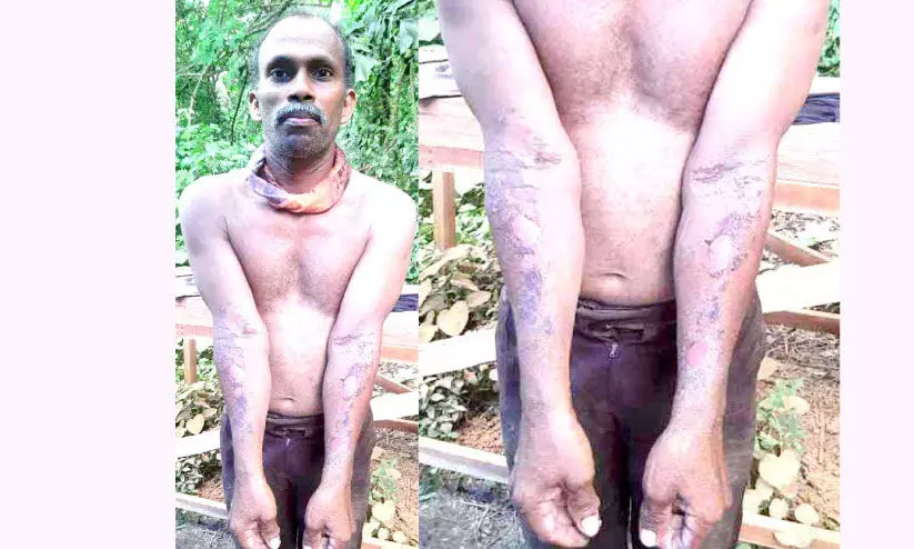 The worker got sunstroke while doing carpentry