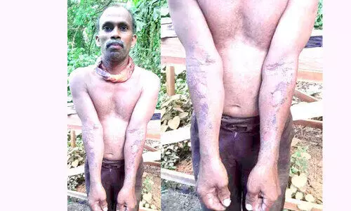 The worker got sunstroke while doing carpentry