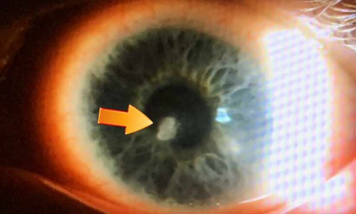 ഭാര്യയുടെ കണ്ണ് അടിച്ച് പൊട്ടിച്ച് കാഴ്ച നഷ്ടപ്പെടുത്തി; ഭർത്താവിന് ഏഴു വർഷം കഠിനതടവും പിഴയും