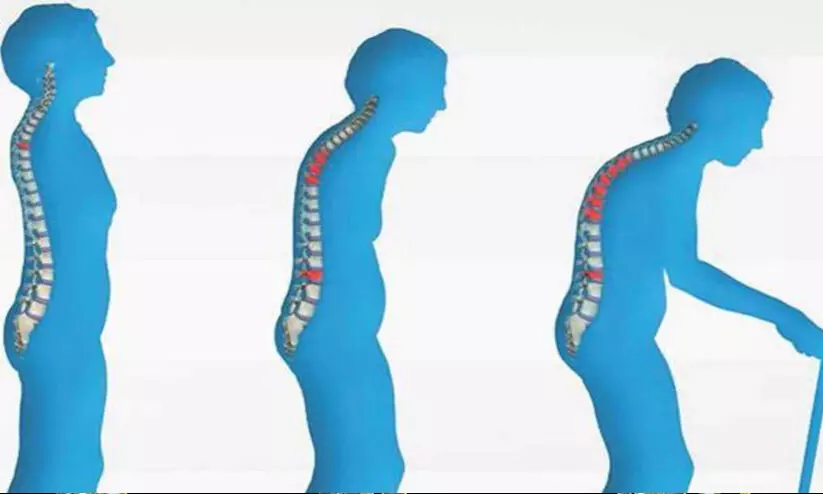 ഓസ്റ്റിയോപെറോസിസ് നിങ്ങളിലുമുണ്ടാകാം നിശ്ശബ്ദമായി